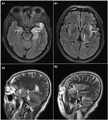 Next-Generation Sequencing Technology Combined With Multiplex Polymerase Chain Reaction as a Powerful Detection and Semiquantitative Method for Herpes Simplex Virus Type 1 in Adult Encephalitis: A Case Report